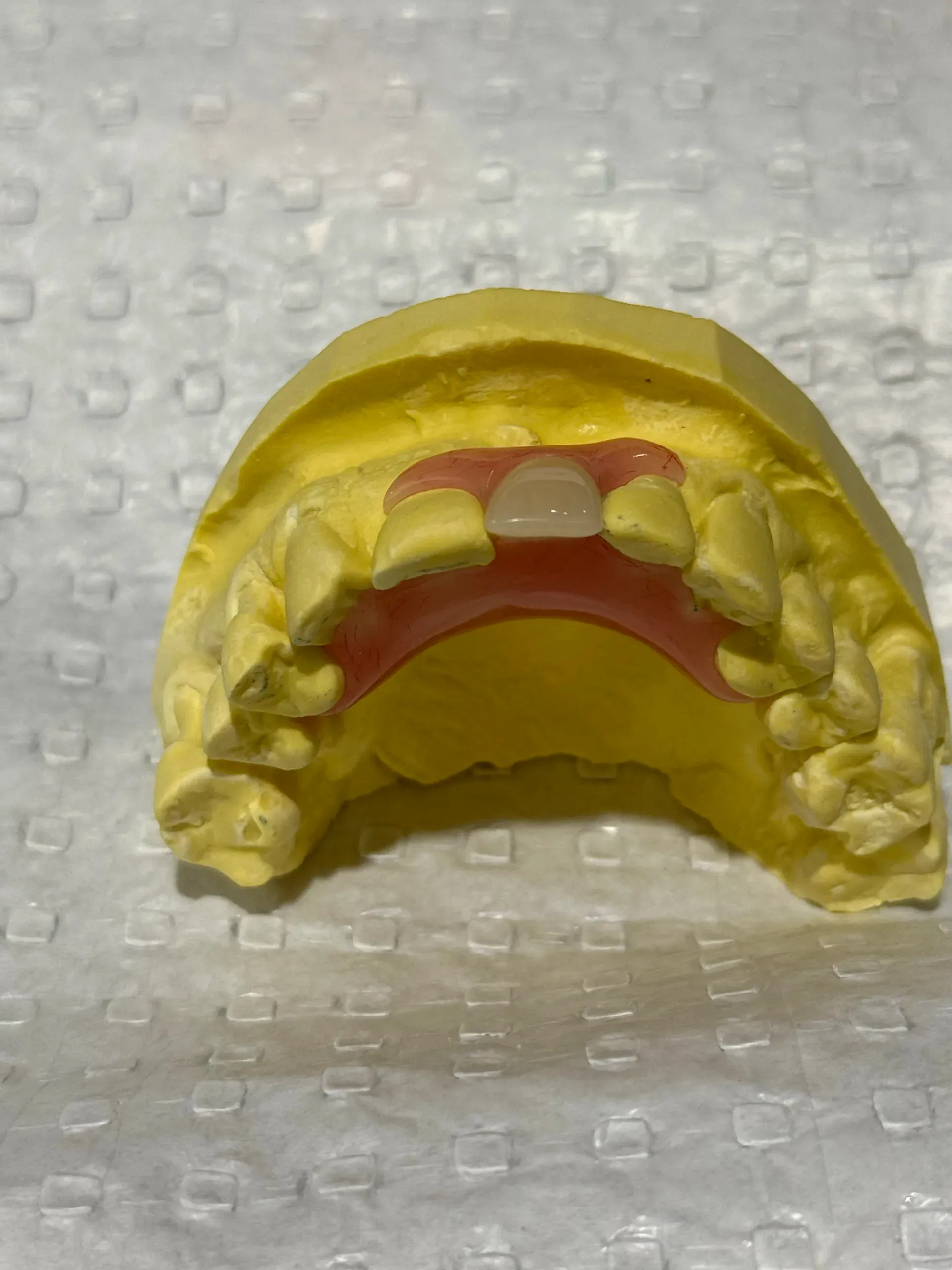 Full Denture