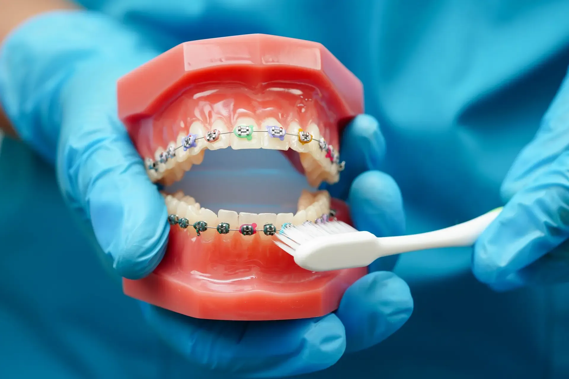 Partial Denture