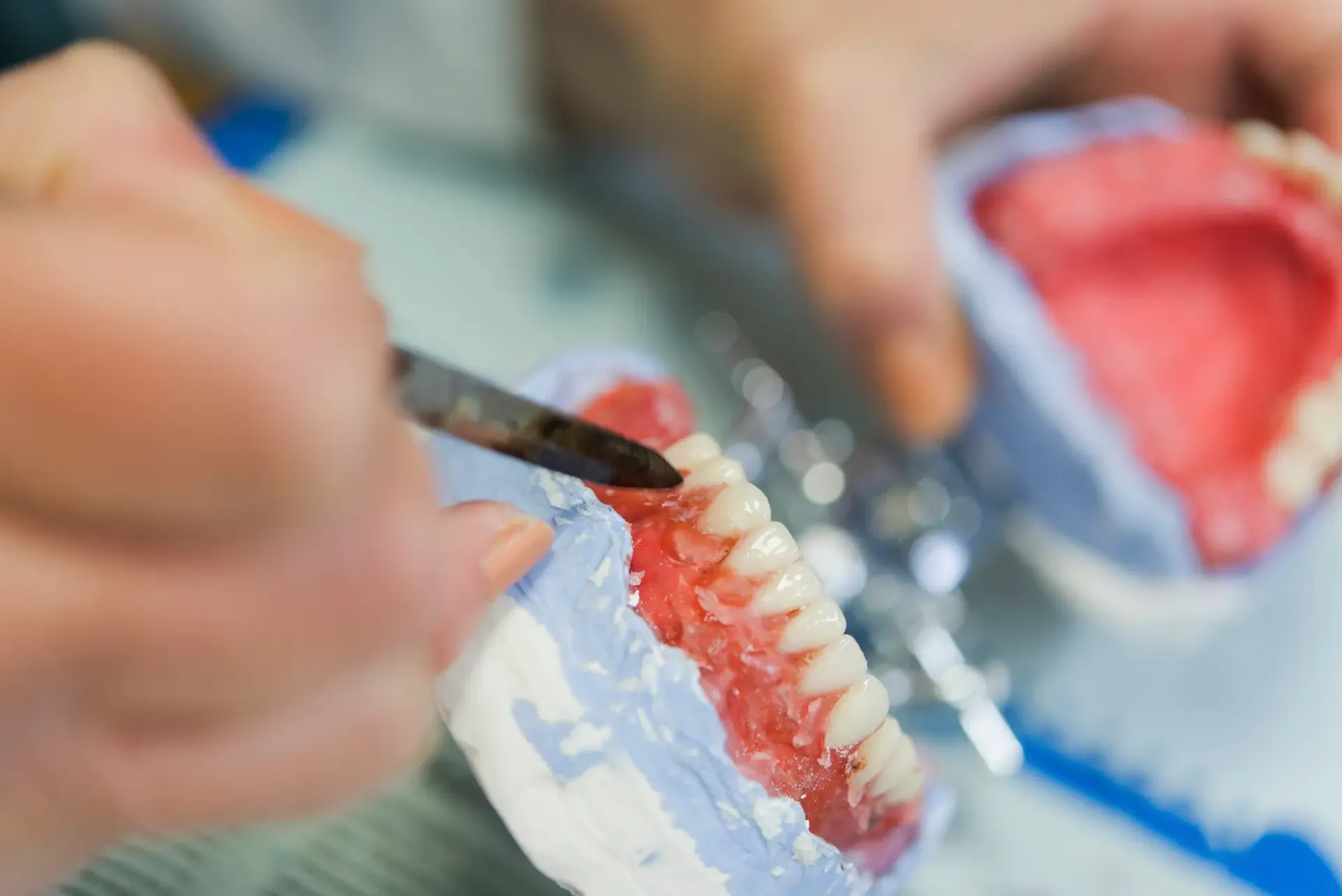 Partial Denture