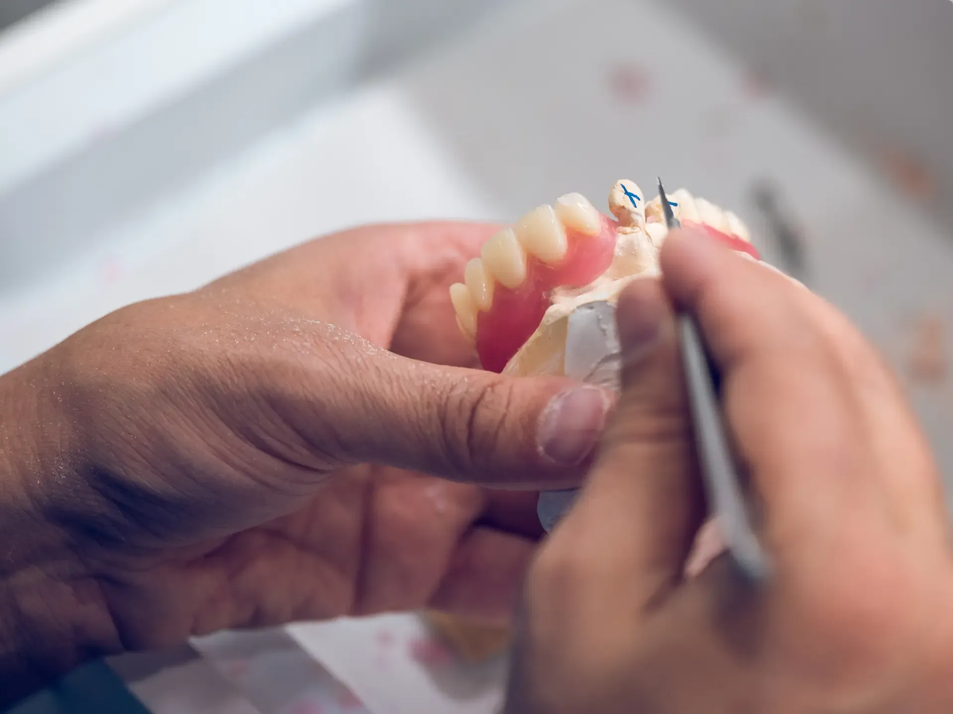 Partial Denture